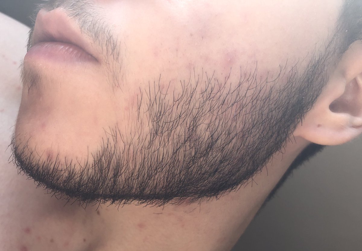 i’m gonna hit 2 years on t next month and this is what my facial hair actually looks like. right side (1st pic and 2nd pics) has less hairs than left side (3rd and 4th pics) and also more acne dkdks but i’m really happy with how it grew 