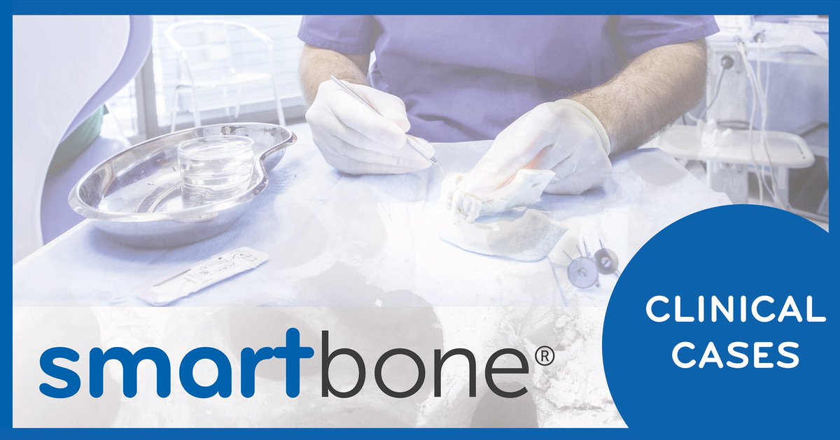 smartboneibi's tweet image. Did you miss some clinical cases about #Smartbone❓
➡️You can find them on our website: lnkd.in/eNtMmbu
➡️Or request your online copy of the #Smartbook (at the end of the following link) inside of which it is plenty of clinical cases: lnkd.in/eFsDv6u 
#clinical