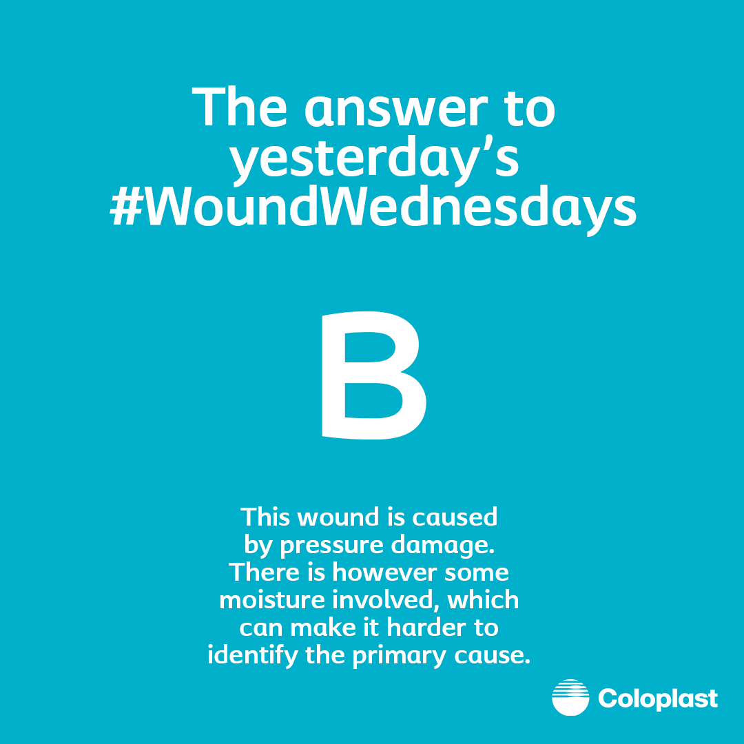 Coloplast_WCare's tweet photo. The answer to this week's #WoundWednesday: B. This wound is caused by pressure damage. There is however some moisture involved, which can make it harder to identify the primary cause. https://t.co/H0lJiUS9oz