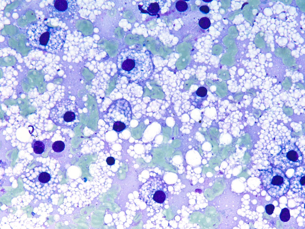 sza_jhcyto's tweet photo. "A Soapy Smear" - Despite the deceptively innocuous look of this adrenal FNA, follow-up histopath revealed an adrenal cortical carcinoma. I almost always report these cases as "Adrenal Cortical Lesion" and leave it to the tissue dx for further characterization. https://t.co/jeXiPxH1J1