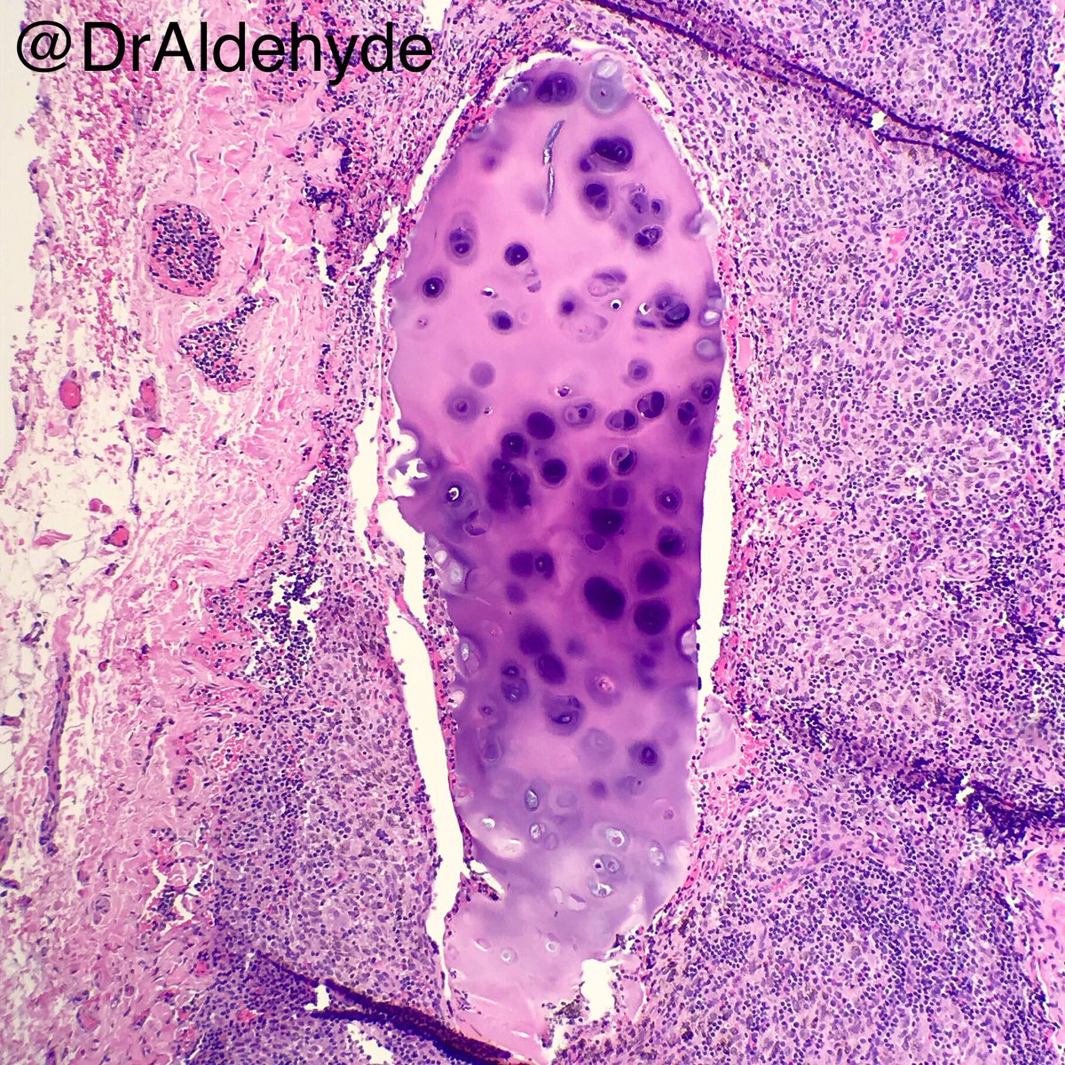 DrAldehyde's tweet image. Incidental cute finding of the day.

Station lymph node. H&amp;amp;E tells you the story even before you dig into EMRs. 😆🔬

Think I saw this finding first through #TwitterPath about a year ago (or was it even before that? Please correct me @smlungpathguy if I am wrong 😆).