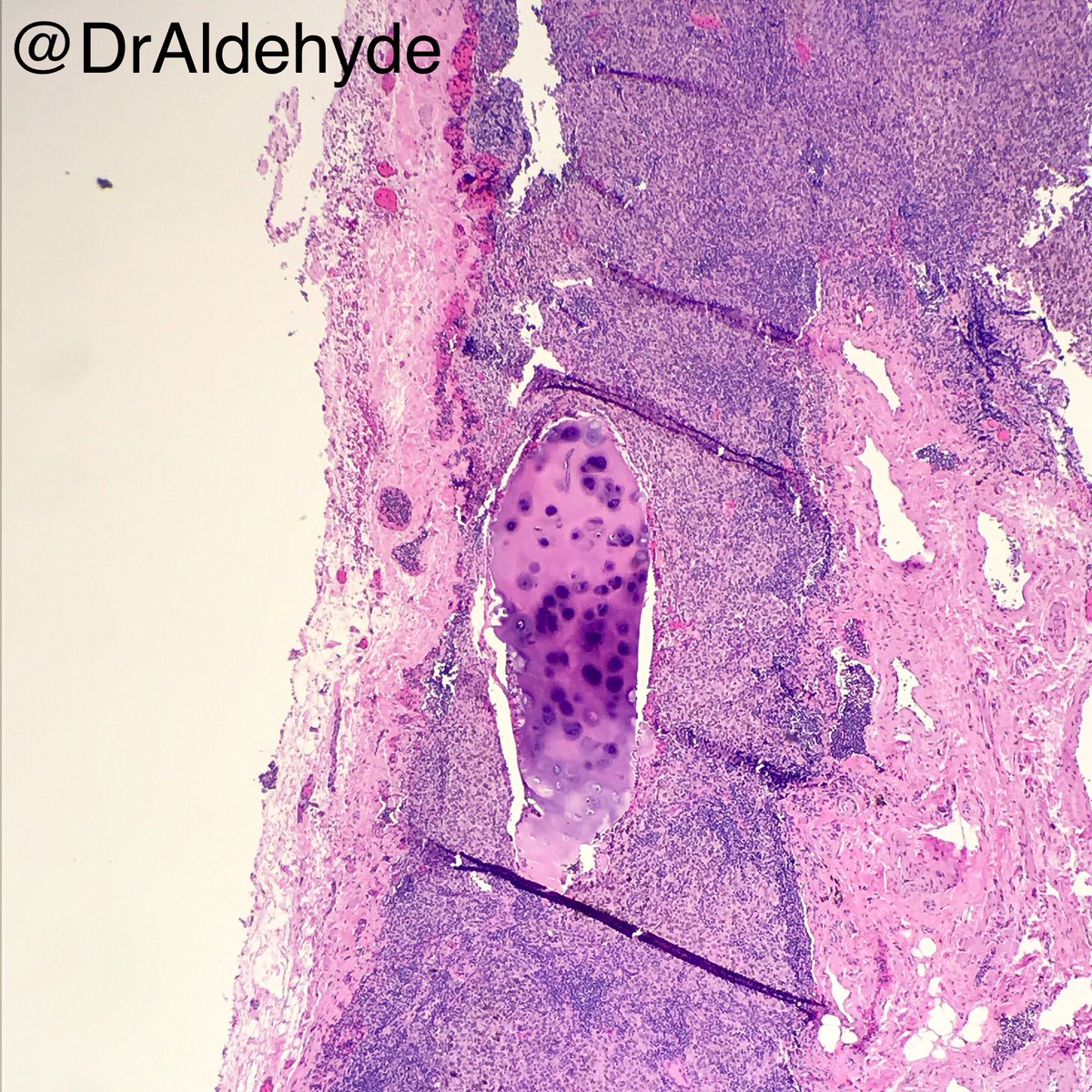 DrAldehyde's tweet image. Incidental cute finding of the day.

Station lymph node. H&amp;amp;E tells you the story even before you dig into EMRs. 😆🔬

Think I saw this finding first through #TwitterPath about a year ago (or was it even before that? Please correct me @smlungpathguy if I am wrong 😆).