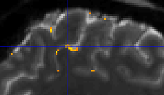 My first attempts on laminar imaging on our Siemens 7T MRI. Shown is the BOLD response  in the hand nob during a finger tapping task. #USC #neuroimaging #brain #neuroscience #USCLONI #ultrahighfield #MRI #7Tesla #laminarimaging #laminarfMRI #sciencetwitter