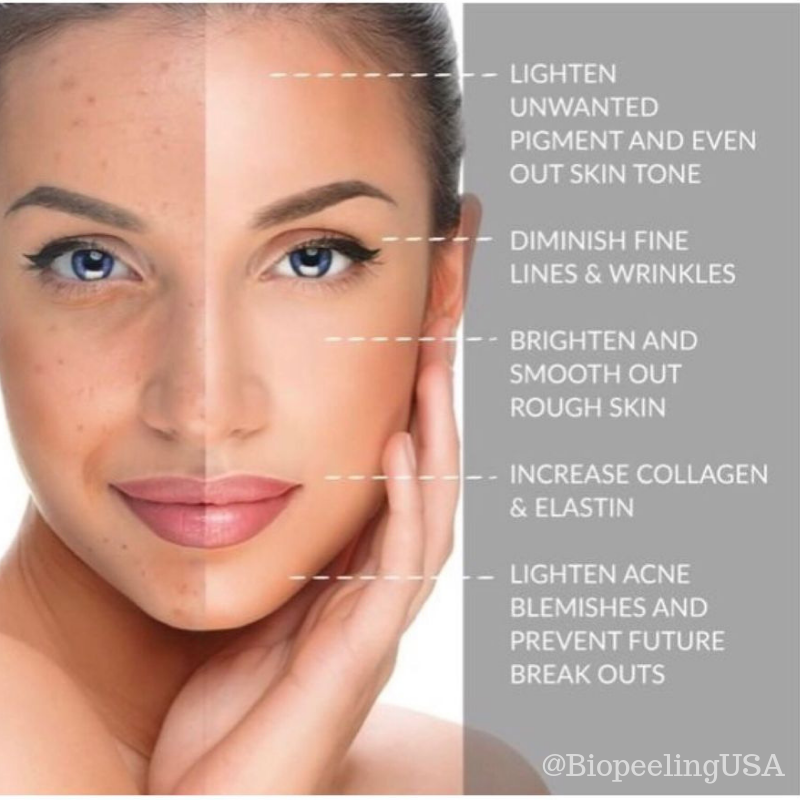 BioPeelingUSA's tweet photo. A #chemical #peel is a technique used to improve the appearance of the skin on the #face, neck or hands. A chemical solution is applied to the #skin that causes it to #exfoliate and eventually peel off. The regenerated skin is usually smoother and less wrinkled than the old skin. https://t.co/JELtXITc2d