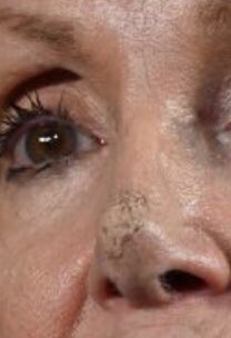 What the hell happened to Nancy Pelosi's nose?