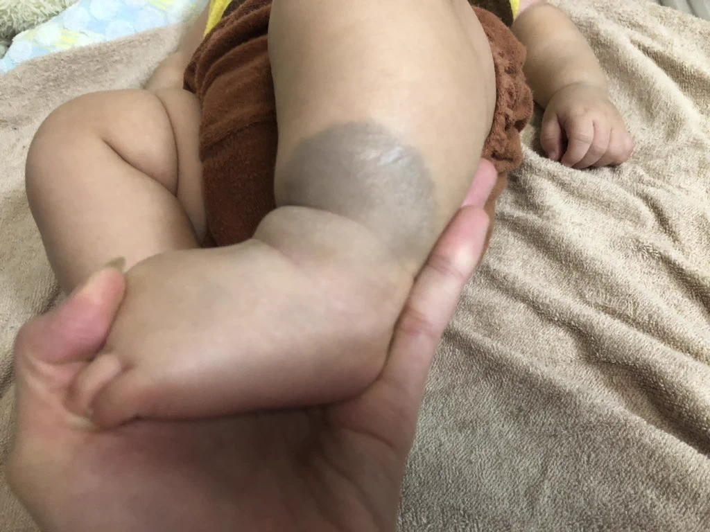 蒙古斑はお尻以外にも出てきます！虐待だと思わないで・・・