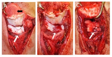 Jennifer8688's tweet photo. Autogenous #Osteochondral #Mosaicplasty for the Treatment of #Osteochondritis #Dissecans of the Humeral Trochlea in a Judo Athlete: A Case Report
https://t.co/XHAvMH4FuE https://t.co/499kmkHjmM