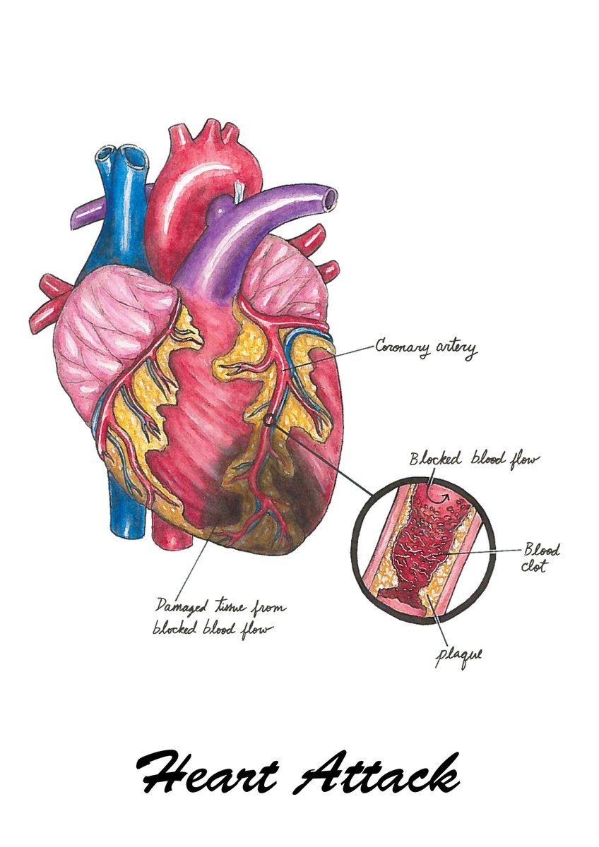 dundeeuni's tweet image. Do you ever find technical medical language confusing? Medical Art Student Karli Mogen’s Masters project relates heart conditions to common phrases, illustrating them to engage the public in anatomy. 

uod.ac.uk/2KWDEwQ

#djcadmastersshow