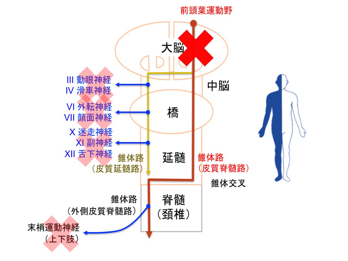 麻痺 右 半身