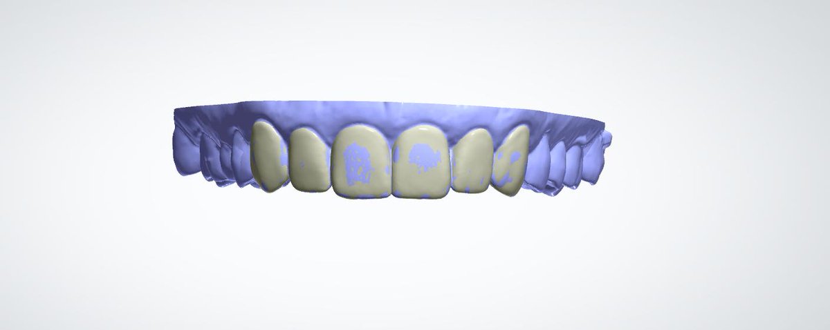 3dentalCADCAM's tweet photo. En #3Dental recibimos modelos físicos para comprobar que los elementos del trabajo encajan a la perfección. Un ejemplo es este caso de carillas fresadas en Empress Multicapa en la que la estética juega un papel fundamental. 
#Empress #Carillas #Estética #Fabricacion #Fresado https://t.co/3QkcCdaIqb