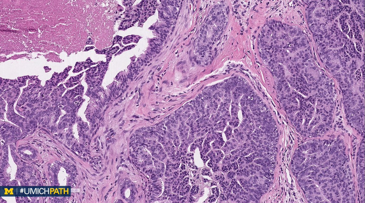 UMichPath's tweet image. 🔬#BreastPath, Day 5

➡️What’s your #DailyDx of this nipple biopsy?

➡️What pattern of CK5/6, ER would you expect?

➡️We’ll tweet the answers, some quick facts, and the next case this weekend! #UMichPath