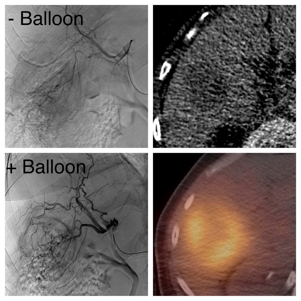 Dr.Mohammed AlNatour (@drnatour) on Twitter photo Sniper balloon occlusion and pressure directed Y90 delivery to treat HCC. Angiograms without and with balloon occlusion performed at same injection rates showing how this can improve tumor filling and penetration <a href="/SIRspecialists/">Society of Interventional Radiology</a> <a href="/SIR_ECS/">SIR ECS</a> <a href="/SIRRFS/">SIR RFS</a> <a href="/UHhospitals/">University Hospitals</a> <a href="/EmbolxInc/">Embolx</a> Sniper balloon occlusion and pressure directed Y90 delivery to treat HCC. Angiograms without and with balloon occlusion performed at same injection rates showing how this can improve tumor filling and penetration <a href="/SIRspecialists/">Society of Interventional Radiology</a> <a href="/SIR_ECS/">SIR ECS</a> <a href="/SIRRFS/">SIR RFS</a> <a href="/UHhospitals/">University Hospitals</a> <a href="/EmbolxInc/">Embolx</a>