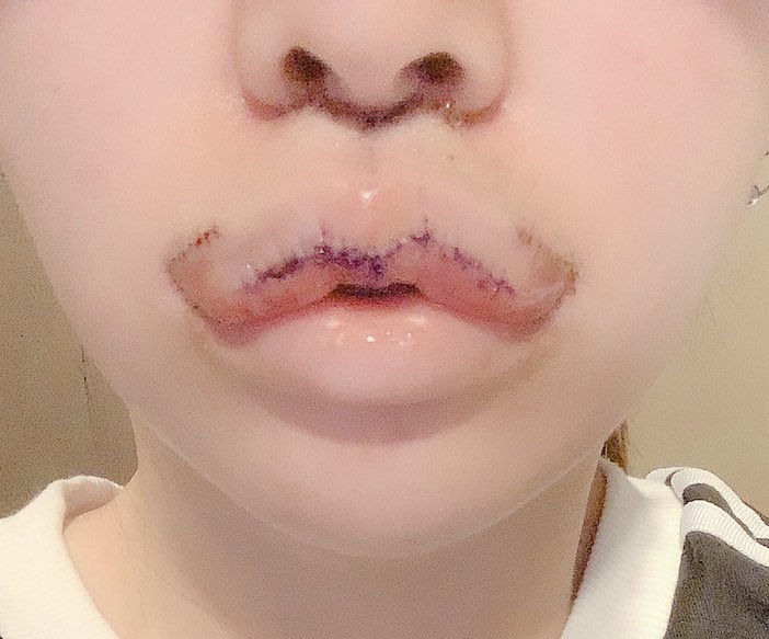 おしゅうちゃん Dt5日目 割と元の唇くらいの大きさに戻ってきた気がするけどまだ多分全然腫れてる 人中まだ長いような気がする 顎ボト打ったら顎短くなったので安易にvラインしなくてよかった