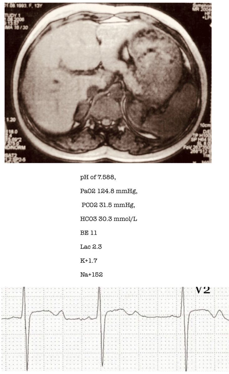 Dr C Kanaris Md Phd Paedtensivist 2 2acronyms Walk F W Fit Well Vpu Alert Ae Air Entry L R Left Right Ddx Differentials Good No Marked This Weeks Pedsicu Fridayquiz Curated By Drdeano On Behalf Of