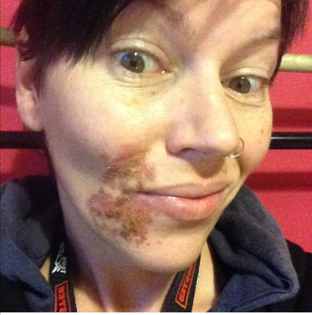 thesaltiestcow's tweet photo. Here's my gentle reminder to wear suncream this el scorchio weekend. Skin cancer isn't pretty, a tan isn't worth this. #dontforgetsuncream #protectyourskin #skincancer #heatwave https://t.co/EFITCOjHHT