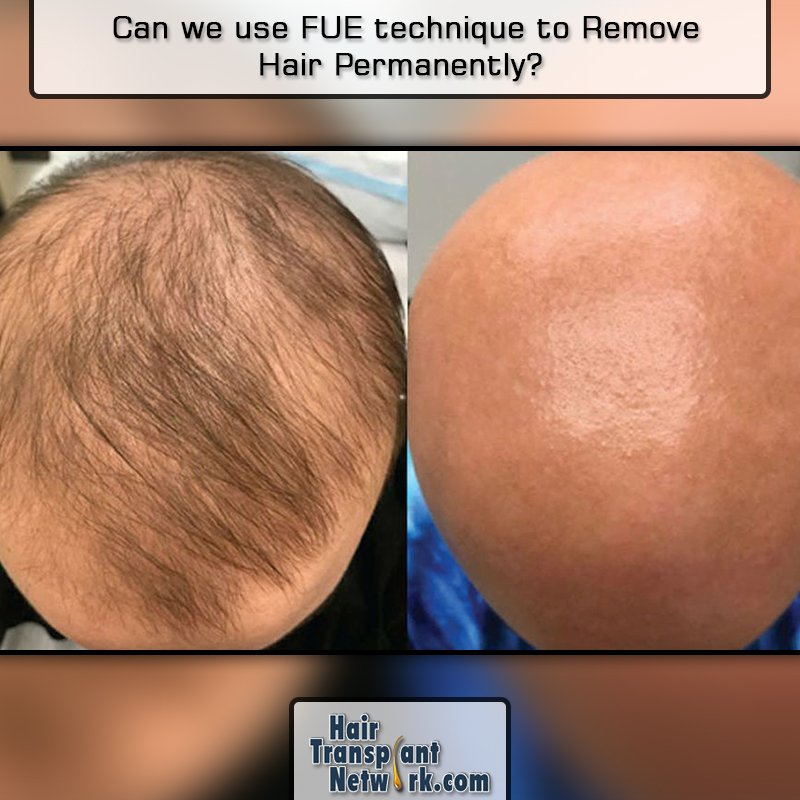 Hair Transplant Network pe Twitter: „Can we use FUE technique to Remove Hair Permanently? Can FUE procedure remove the hair follicle permanently, instead of putting it back in somewhere else? /fD0mcL5XH5 #FUE_technique # Hair Transplant Network pe Twitter: „Can we use FUE technique to Remove Hair Permanently? Can FUE procedure remove the hair follicle permanently, instead of putting it back in somewhere else? /fD0mcL5XH5 #FUE_technique #