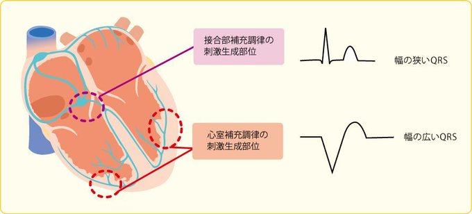 調律 補充 分かる！完全房室ブロックの心電図