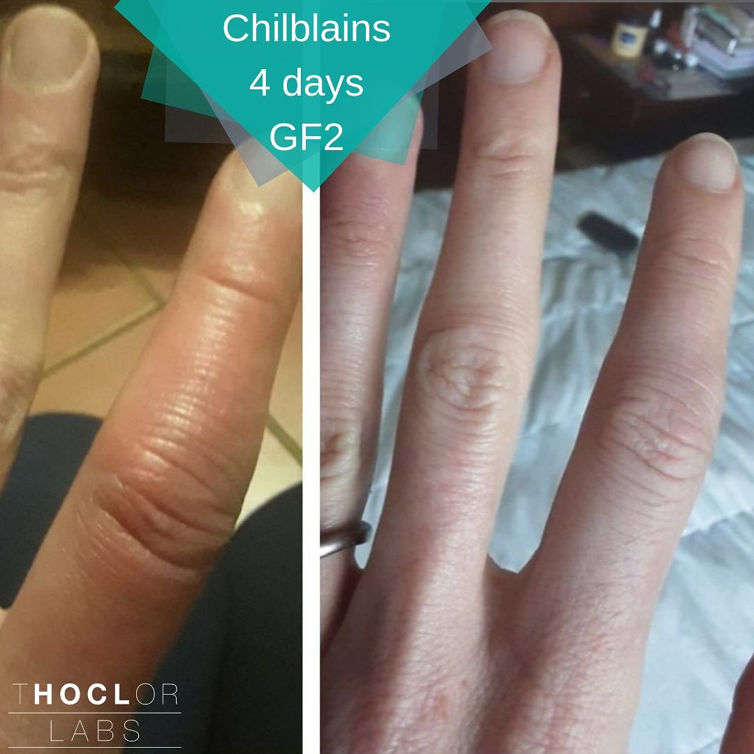 ThoclorLabs's tweet photo. Are you struggling with dry, split, painful winter hands or, worse yet, from #chilblains? We received this result recently from a lady who used GF2 for 4 days on her hand and wow ... look at the difference.⁣⁣
⁣⁣#skinsmiraclemist #saveyourwinterhands #GF2 #naturalhealing https://t.co/elj4kzeeFL