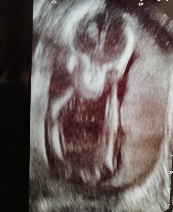 My sweet fairy baby girl playing peek a boo at Dr's yesterday only 17 weeks to go https://t.co/AWLTu