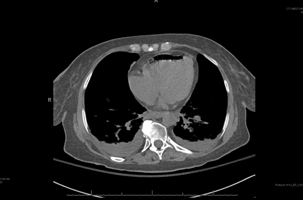 Anterior-most chamber of the heart is right ventricle. Here's an axial CT image of an air embolism with air in right ventricle. (credit  https://coreem.net/core/air-embolism/)6/