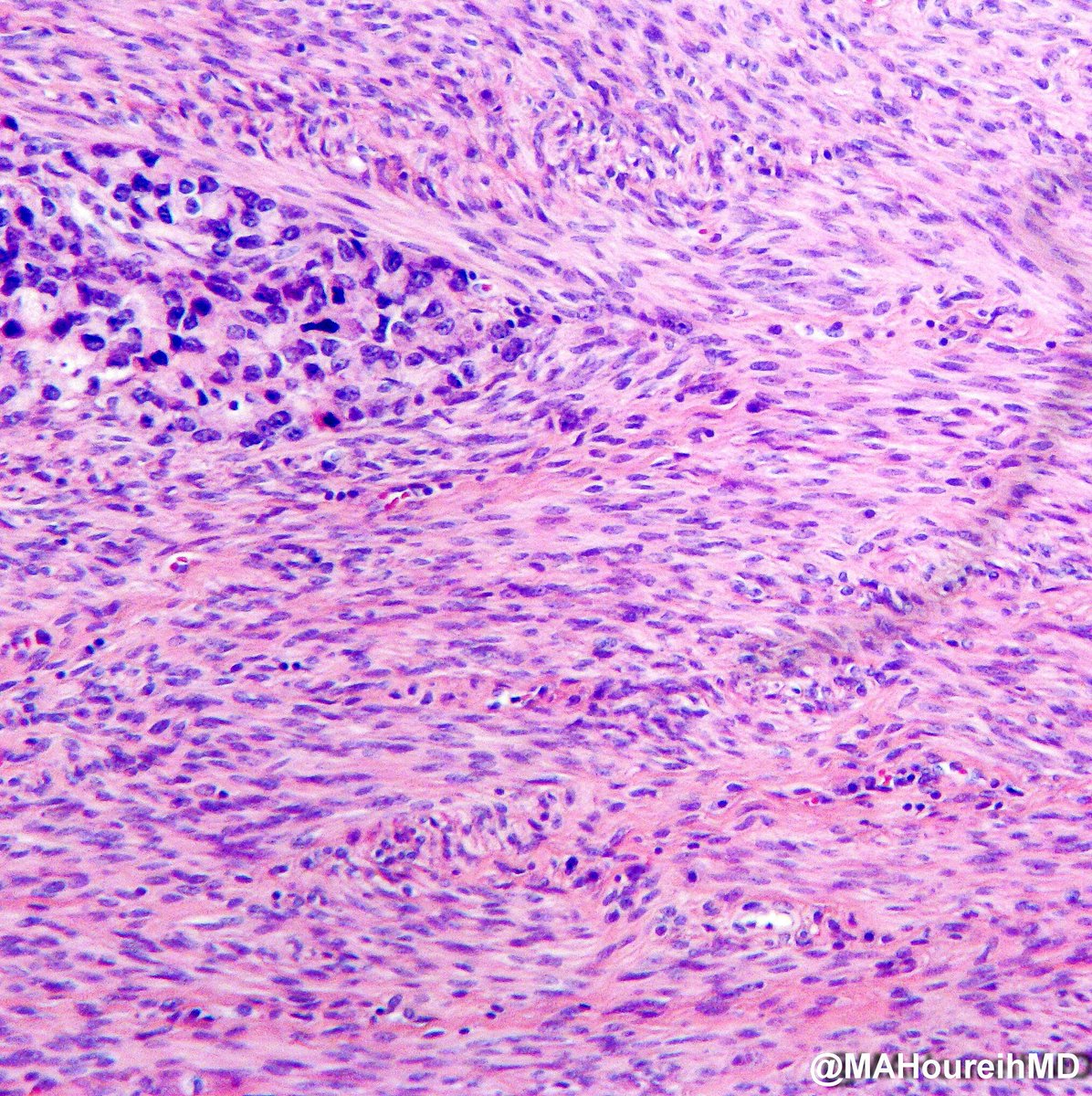 MAHoureih's tweet photo. #pathquizz for this weekend! Could you make a guess on what the following images represent? @tralimiguel @DrRolaAli @DrMarkOng @Histopatolomon @AyshaMubeen86 @D4L14H @preethijaison @sam_albadri @ariella8 @preethijaison @Pathmath1 @vi_monappa @kriyer68 @BinXu16 @smlungpathguy https://t.co/xE2kQzfUKu