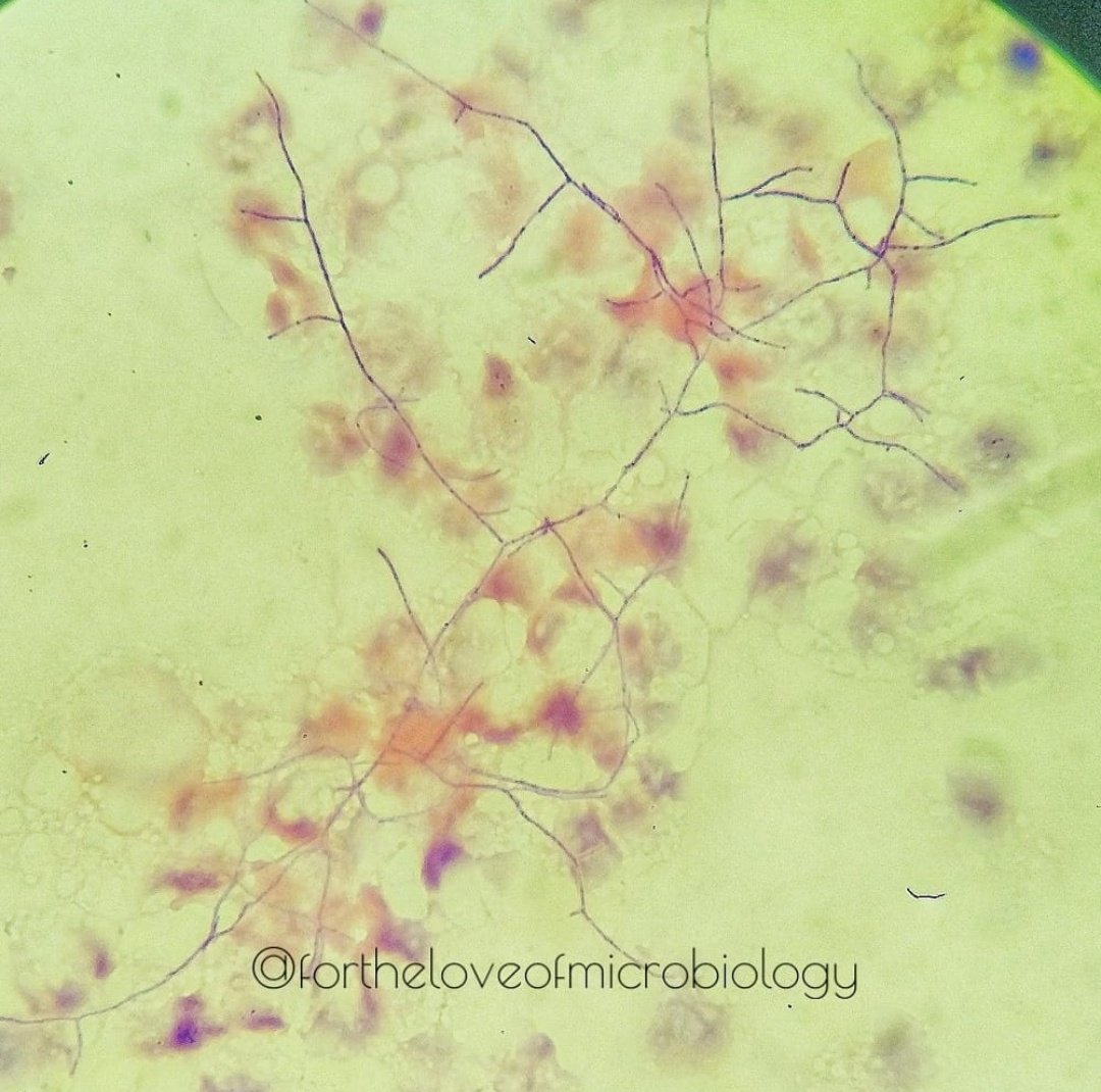 fortheloveofmi2's tweet photo. Gram positive beaded branching rods seen on a gram stain from a lumbar abscess sample. Highly suggestive of Nocardia. 

 #microround #Microbiologypakistan #microbiology https://t.co/9IAAe6ttd8