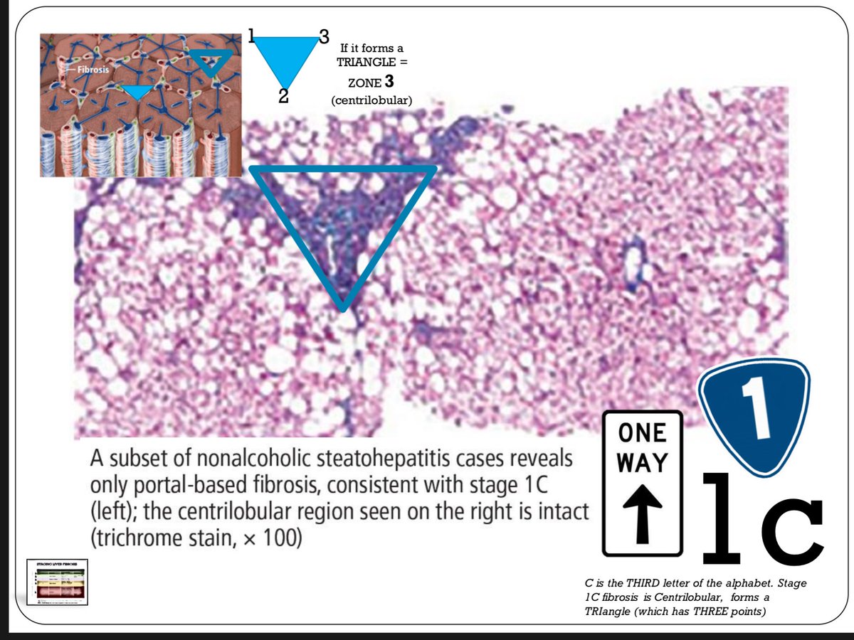HeartPathology's tweet photo. A few more snapshots into an interactive tutorial for liver biopsy interpretation... helpful tricks to remember how to stage fibrosis in chronic liver disease 

#IHeartPathology #Liverpath #GIPath #PathTweetAward https://t.co/RhSF3j50HB