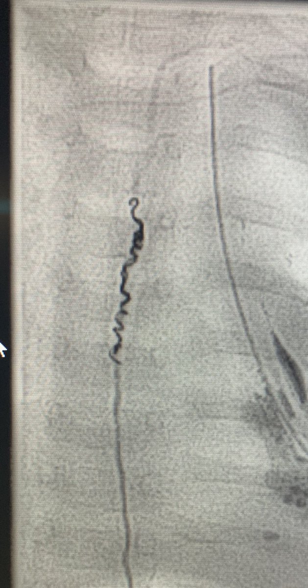 Victoria Young (@vyoungmd) on Twitter photo Double aortic arch repair c/b thoracic duct ligation -> thoracic duct embo. #IR #pedsIR #stopthechylothorax #MRLymphangiography <a href="/JLR_IR/">Jamie RiChard</a> <a href="/shamitsdesai/">Shamit Desai MD</a> @drseedial <a href="/SDhandMD/">Sabeen Dhand</a> <a href="/vogelzang252/">Bob Vogelzang</a> <a href="/rkryu/">RK RYU</a> <a href="/kush_r_desai/">Kush Desai</a> <a href="/SIRspecialists/">Society of Interventional Radiology</a> Double aortic arch repair c/b thoracic duct ligation -> thoracic duct embo. #IR #pedsIR #stopthechylothorax #MRLymphangiography <a href="/JLR_IR/">Jamie RiChard</a> <a href="/shamitsdesai/">Shamit Desai MD</a> @drseedial <a href="/SDhandMD/">Sabeen Dhand</a> <a href="/vogelzang252/">Bob Vogelzang</a> <a href="/rkryu/">RK RYU</a> <a href="/kush_r_desai/">Kush Desai</a> <a href="/SIRspecialists/">Society of Interventional Radiology</a>