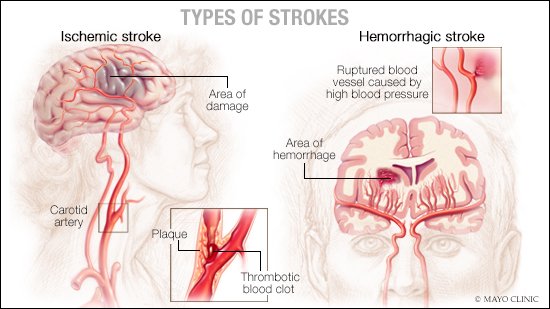 MayoClinic's tweet photo. #ScienceSaturday: #Stroke is the leading cause of permanent disability in the U.S., striking nearly 800,000 people each year, according to @CDCgov. Mayo researchers are studying #StemCellTherapy for stroke patients. https://t.co/4HIHWYivKb #RegenerativeMedicine https://t.co/OIUBqIM0Ds