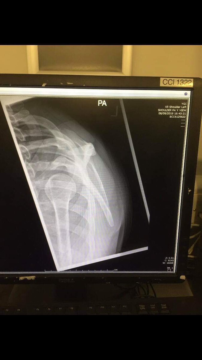 StaceyLouise93's tweet image. Not quite how I planned starting off the season... 🙈 #dislocated #rugby #shoulder