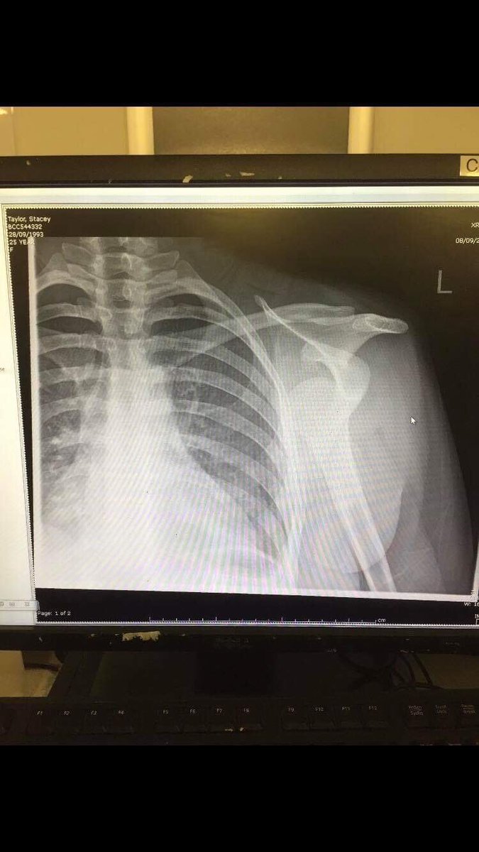 StaceyLouise93's tweet image. Not quite how I planned starting off the season... 🙈 #dislocated #rugby #shoulder