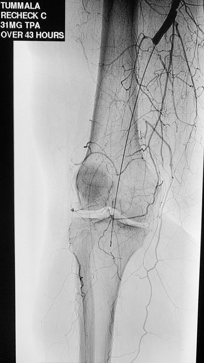t_intheleadcoat's tweet photo. Acute leg ischemia, meth use, post tpa 43 hours at 1 mg/ hr ... no angiographic or clinical improvement. Intact motor function, diminished sensation. What treatment options do we have? @kmadass @SriniTummala @keithppereira @KprasMD @LessneVIR @SDhandMD #irad #coldleg @CLIfighters https://t.co/Amw4VMZ8n3