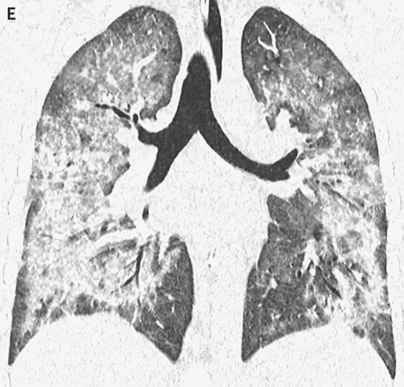 AndyBiotech's tweet photo. NEJM case series today on #Vaping-Induced Lung Injury after CDC safety warning
https://t.co/YT9pF9dq2s
https://t.co/t6PzLsewER

Some pretty scary lung CT scan images, better avoid #ecigarettes folks...
https://t.co/GZf9qz1Bje
https://t.co/WxRstPd0NT
https://t.co/lwPaQhMqsm https://t.co/9jBUlKXcg2