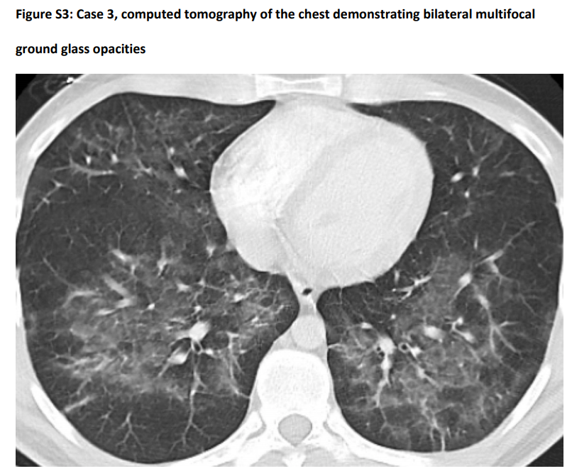 AndyBiotech's tweet photo. NEJM case series today on #Vaping-Induced Lung Injury after CDC safety warning
https://t.co/YT9pF9dq2s
https://t.co/t6PzLsewER

Some pretty scary lung CT scan images, better avoid #ecigarettes folks...
https://t.co/GZf9qz1Bje
https://t.co/WxRstPd0NT
https://t.co/lwPaQhMqsm https://t.co/9jBUlKXcg2