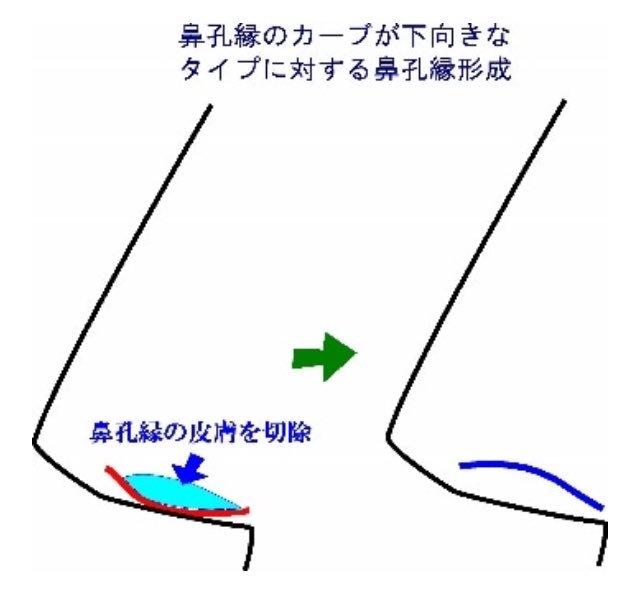 0404_aoe's tweet photo. 理想的な鼻孔縁への施術まとめ👃

🔹ほぼまっすぐ
→鼻中隔延長
🔹上向きが僅かで下向きカーブがほとんど
→鼻翼上挙術
🔹ほぼ下向きカーブ
→鼻孔縁形成

理想な上向きのカーブの鼻孔縁が欲しいですね…✨ https://t.co/VB9gHqI2Q2