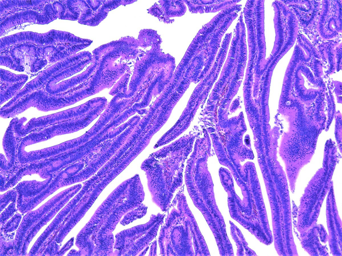 Patholwalker's tweet photo. Papillary adenocarcinoma of ascending colon. Right hemicolectomy, HE and endoscopic image. #pathology #GIpath https://t.co/NcZ2F7GODk