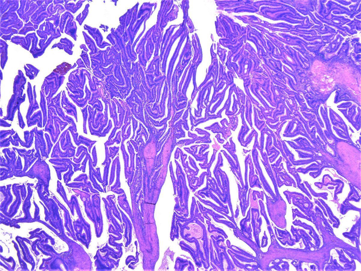 Patholwalker's tweet photo. Papillary adenocarcinoma of ascending colon. Right hemicolectomy, HE and endoscopic image. #pathology #GIpath https://t.co/NcZ2F7GODk