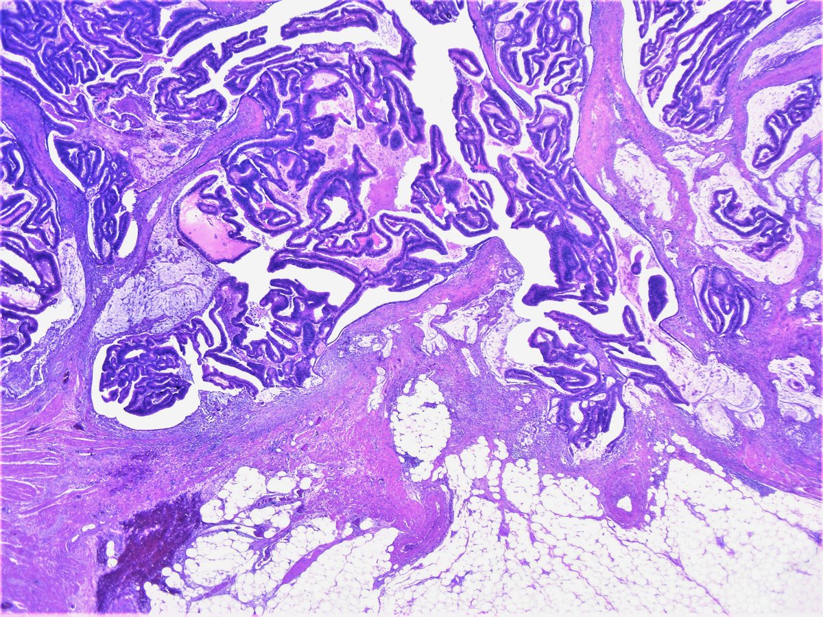 Patholwalker's tweet photo. Papillary adenocarcinoma of ascending colon. Right hemicolectomy, HE and endoscopic image. #pathology #GIpath https://t.co/NcZ2F7GODk