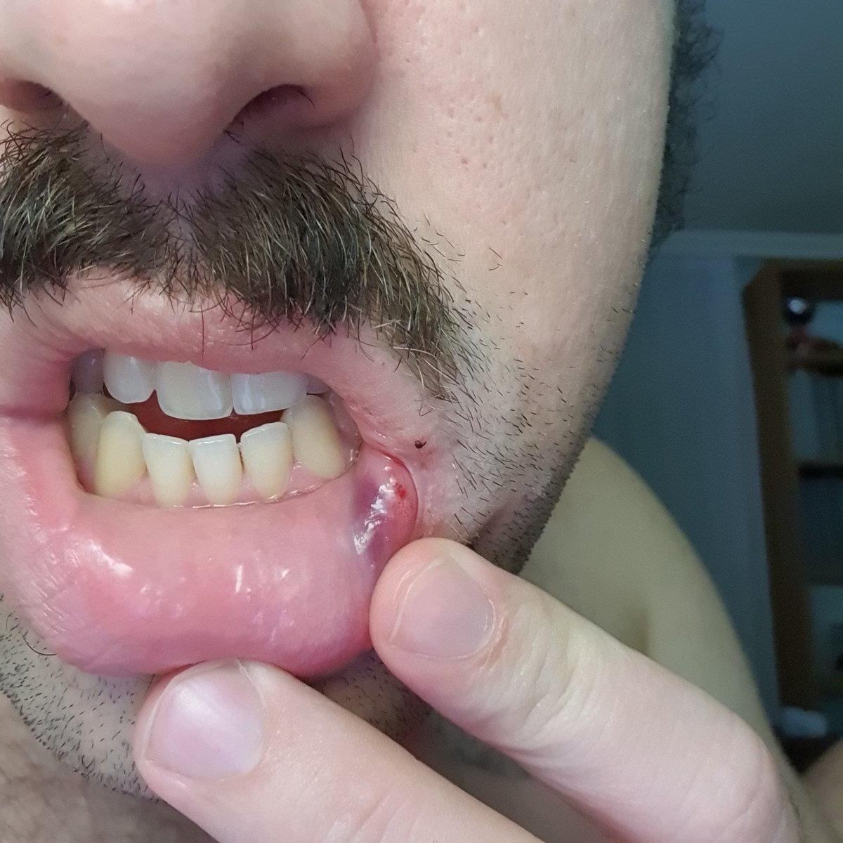 Anoche sufrí una agresión. Una agresión homófoba. 

Al salir de la #FeriaDeMurcia 3 individuos estaban maltratando y apedreando a unos patos en el río mientras lo grababan con sus teléfonos. 

Al reprenderles, uno me golpeó por lo que ya imagináis. Denuncia puesta. Ya está bien.