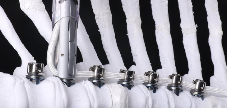 Ryortho1's tweet image. THE first spinal tethering device for scoliosis patients has been approved by the FDA.  Interesting new product. Everyone should check this out. ow.ly/uM4I50w0TkV

#IdiopathicScoliosis #ZimmerBiomet #TheTether #BaronLonner ryortho.com/breaking/dynat…