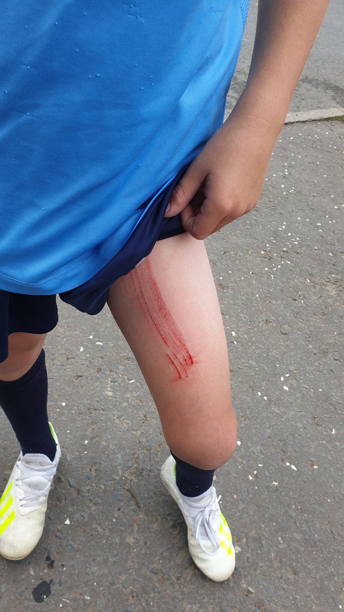 naidier57's tweet photo. The wee man spotted the @NorthernIreland team training at stormont today, climbed a tree to get glimpse at his idols, all was going well until a wasp came and he let go and fell.. was still happy to see @JonnyEvansFans @StevenDavis8 @KyleLafferty_09 war wounds for zee Germans https://t.co/3aCKChty00