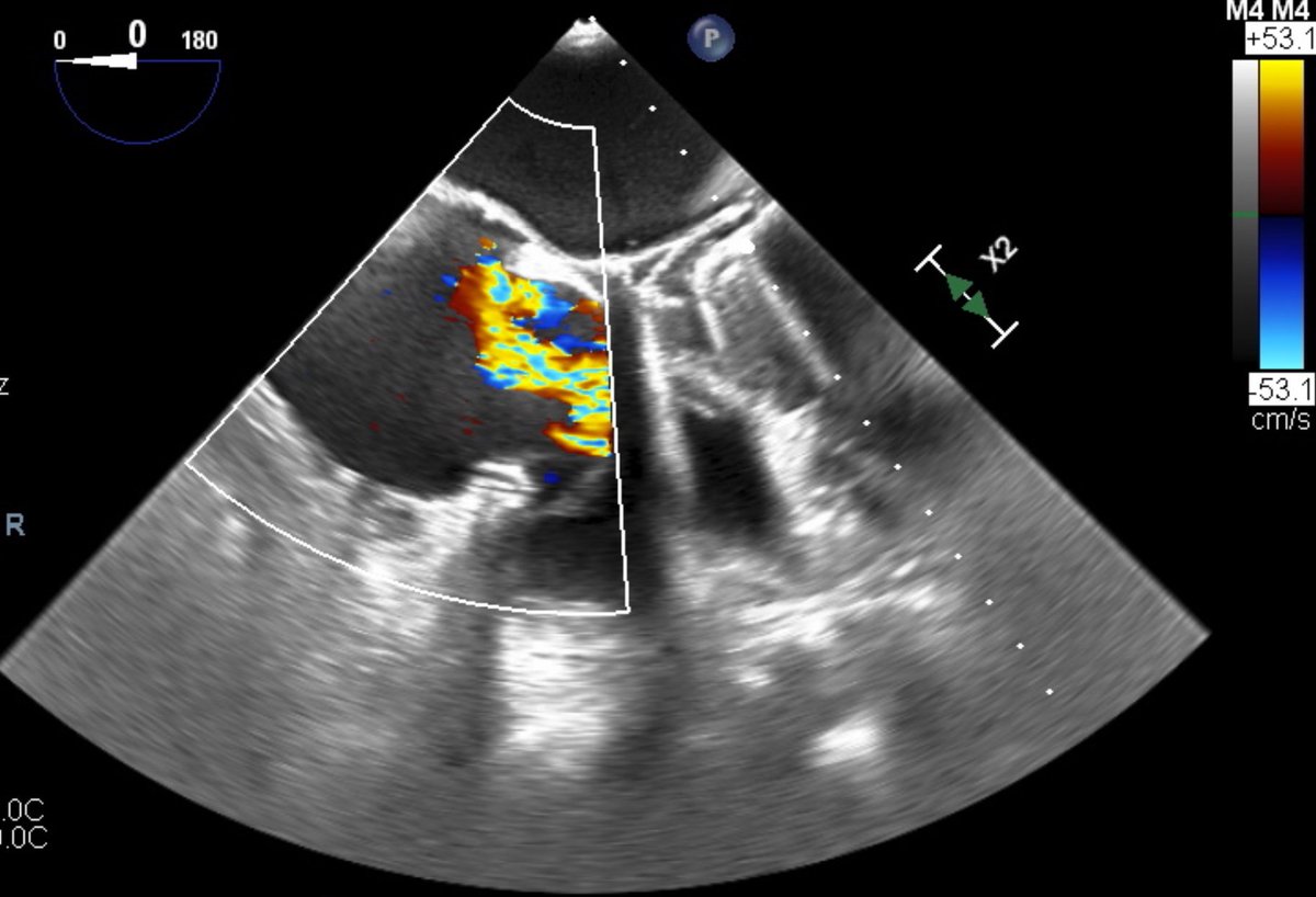 FIRST Spain transcatheter tricuspid annuloplasty using Edwards Cardioband successfully undertaken #HospitalRamonyCajal. Impressive reduction in TR without surgery. Thanks to echo and cath lab team and @EdwardsLifesci