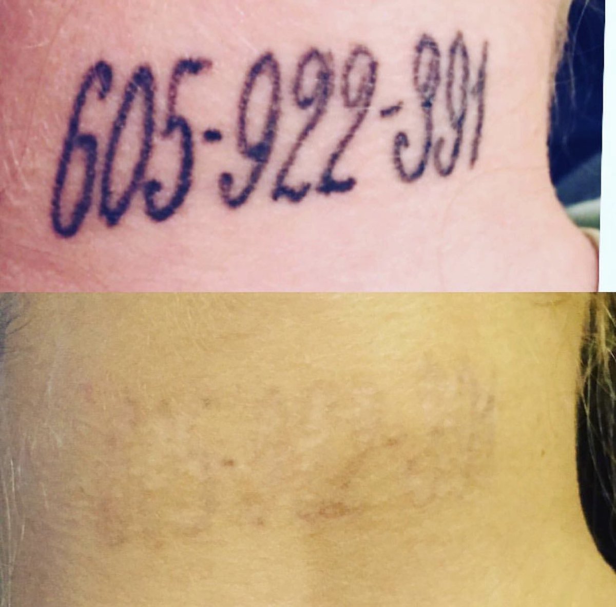 tattooremovalga's tweet photo. #Repost 4 treatments! https://t.co/Q2NkJzniVf