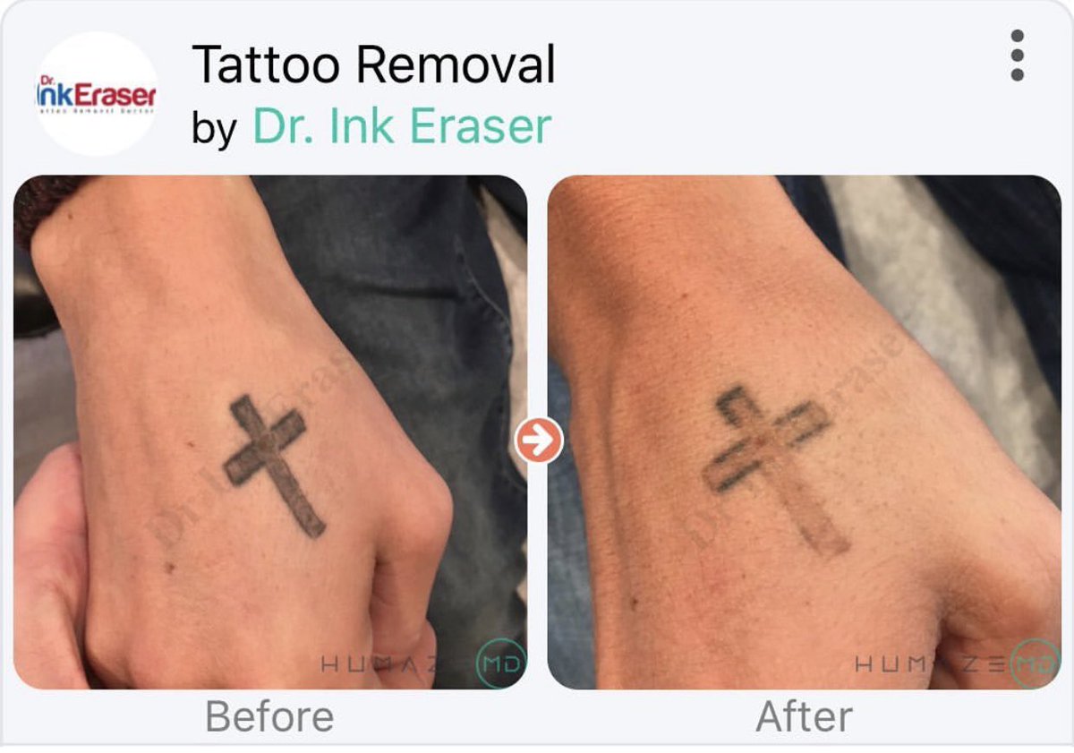 tattooremovalga's tweet photo. After 2 treatments 
One use of PFD Patch 👏🏼👏🏼 https://t.co/CK6Q4Ji2NE