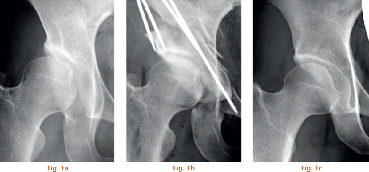Surgeons investigate the association between the copy number variation of the ASPN gene and acetabular dysplasia (AD) to identify a possible genetic structural variation that confers a risk of AD ow.ly/VZ2P50vZ5Oa #acetabulardysplasia #copynumbervariation #genetics