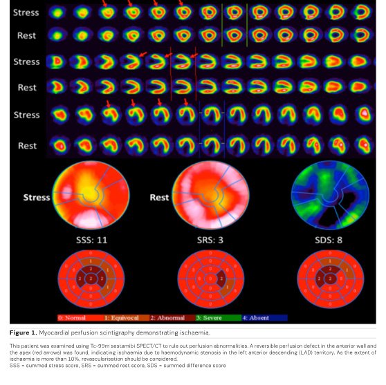 What is Nuclear Cardiology? - Christoph Rischpler, explains how, In #nuclear #medicine, #molecular probes are administered to #patients at #nano- or #picomolar concentrations in order to visualise processes #non-invasively in the #body.. iii.hm/y6j