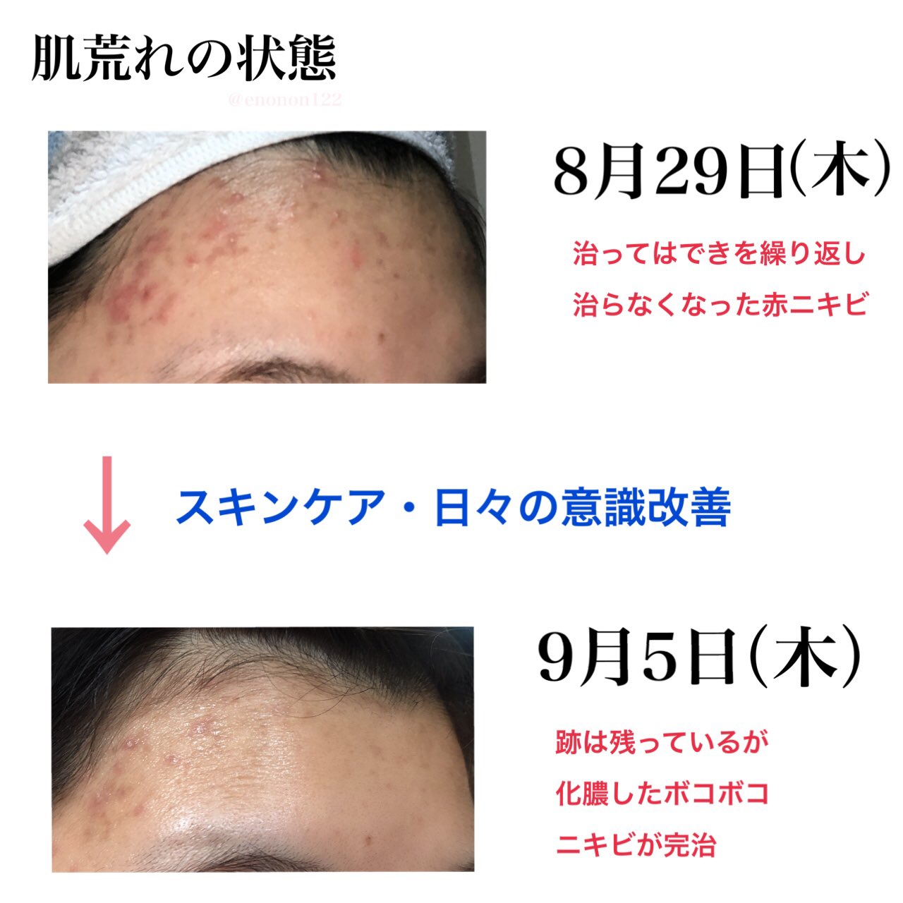 تويتر エノ على تويتر 使用している薬は 皮膚科で処方していただいたベピオゲルです 塗った後乾燥して皮膚が剥けてきてしまうことがあるのでしっかり保湿して使うことが大切です 小さなニキビ の治りはとても良いですが おでこの頑固なニキビはこれだけでは治せませ