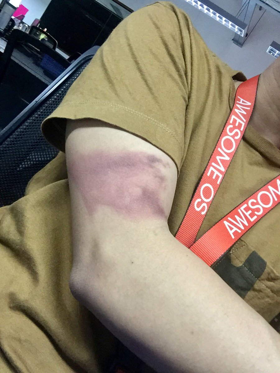 rxmark1228's tweet photo. Day 1 - 3 
Sakit pa sa gibulagan hahaha 🔥 https://t.co/bnVNbZaDOI