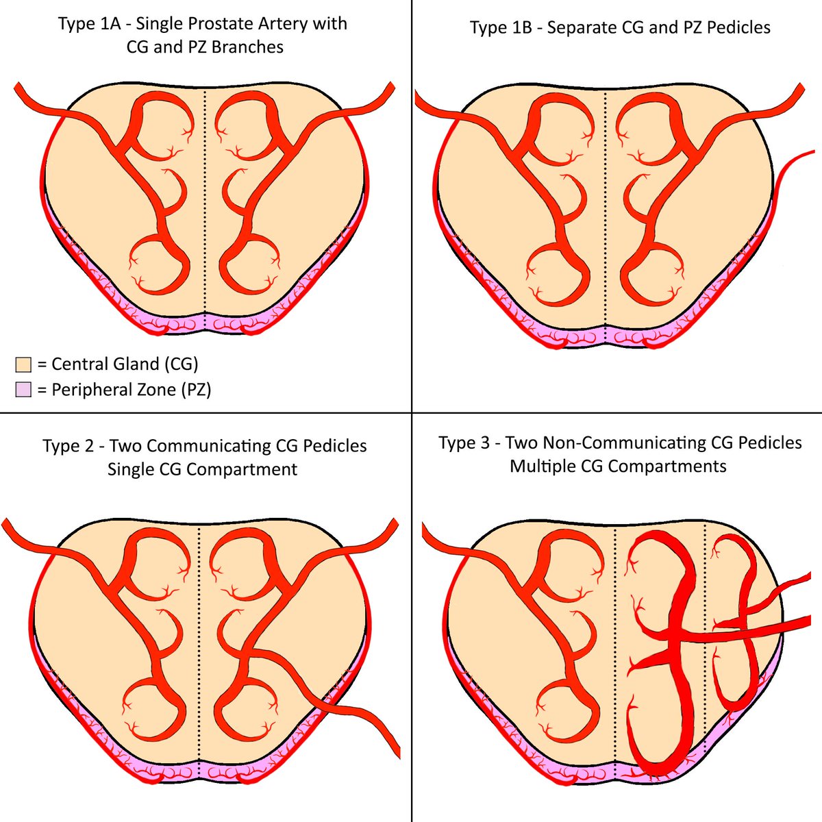 jdemeritt's tweet photo. @AriIsaacsonMD @matt_coward Nice example of a type 3 vascularization pattern! https://t.co/zQawGGCDXO