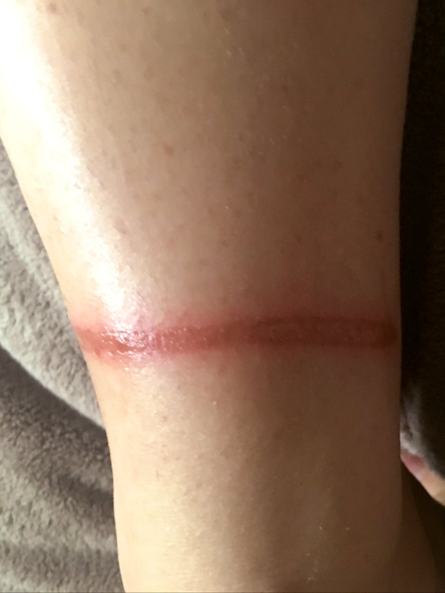 NicoleBeckwith's tweet photo. This is the back of my ankle after my 12 pound dog decided to chase a stray cat and I happened to be between the two. She got me with her cable. This is painful and I take pain well. I think I need to go back to work before something kills me 😂 https://t.co/ecoz30p8iy